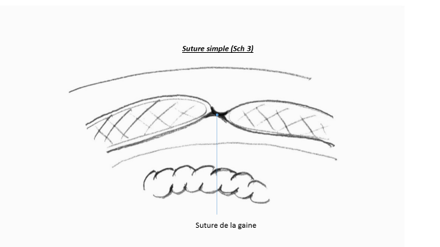 suture-simple.png