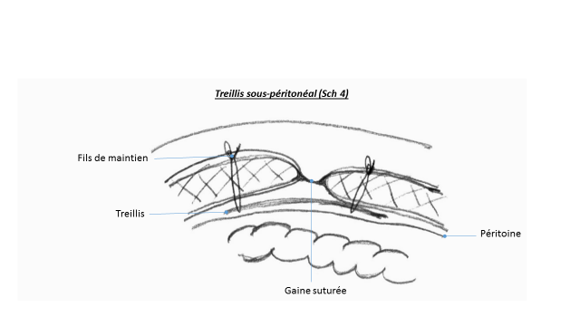 treillis-sous-péritonéal.png